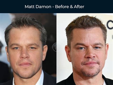 58 Celebrities with Hair Transplant (Cost, Before & After).
